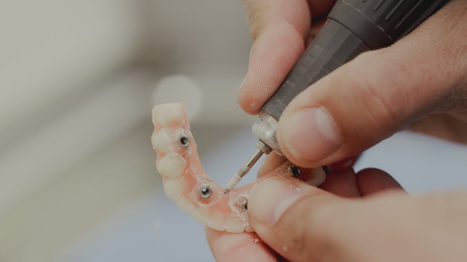Implantes Que Parecem Seus: Como Conseguimos um Sorriso Natural Sobre Implantes Dentários — Instituto AreLuna