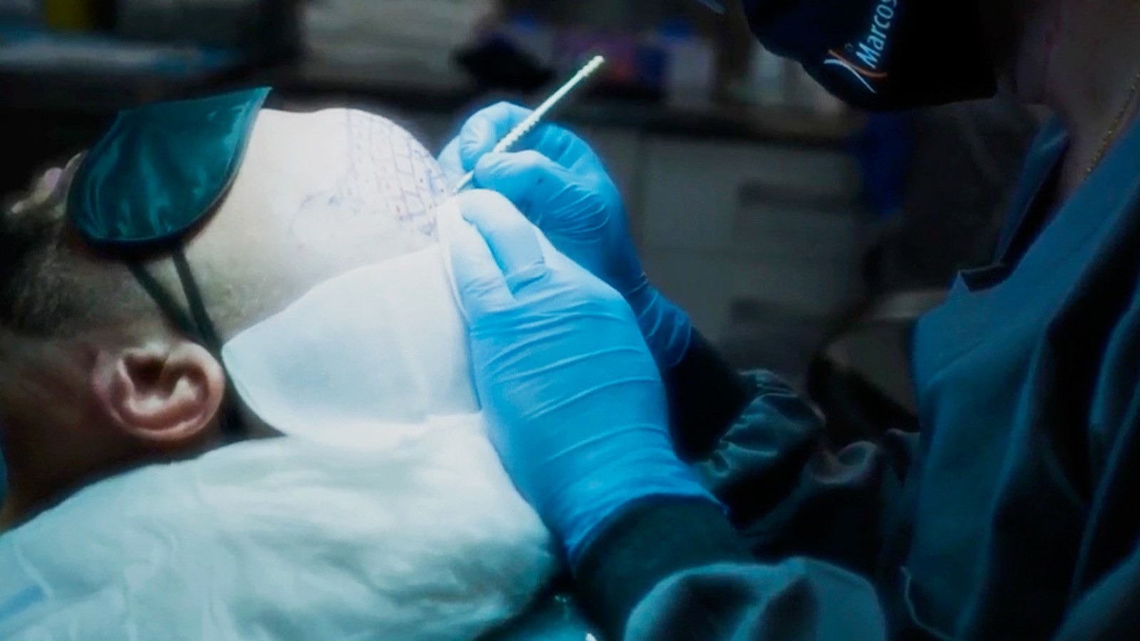 Transplante Capilar Para Mulheres: O Que Muda na Técnica e nos Resultados — Instituto AreLuna